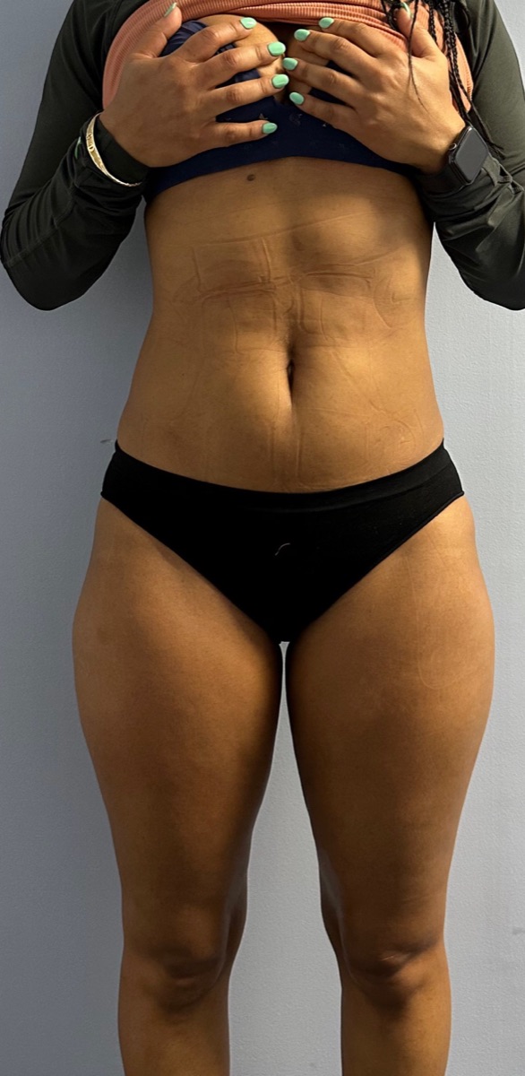 A client's smooth, contoured waist after body treatments