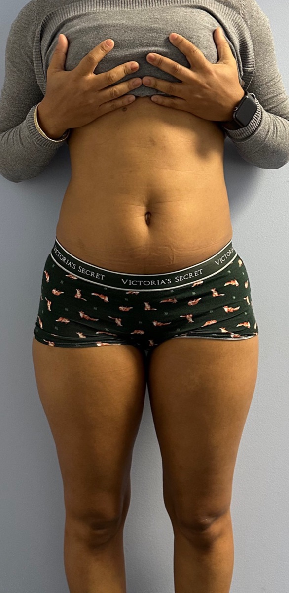 Before: a client's waist and stomach