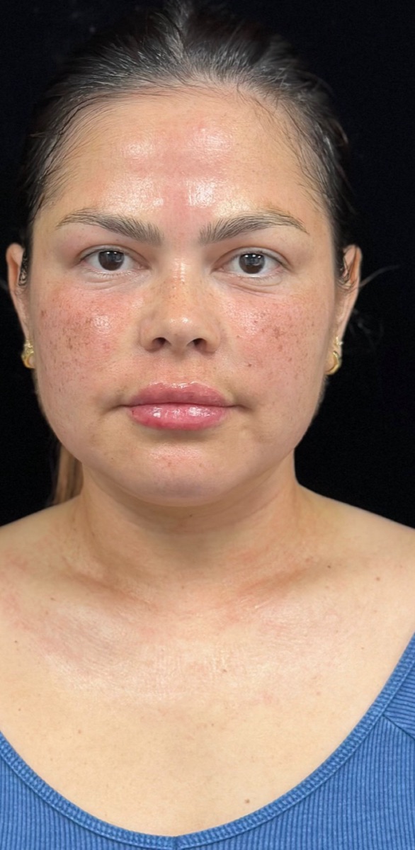 After: the same client's face looking brighter and more even