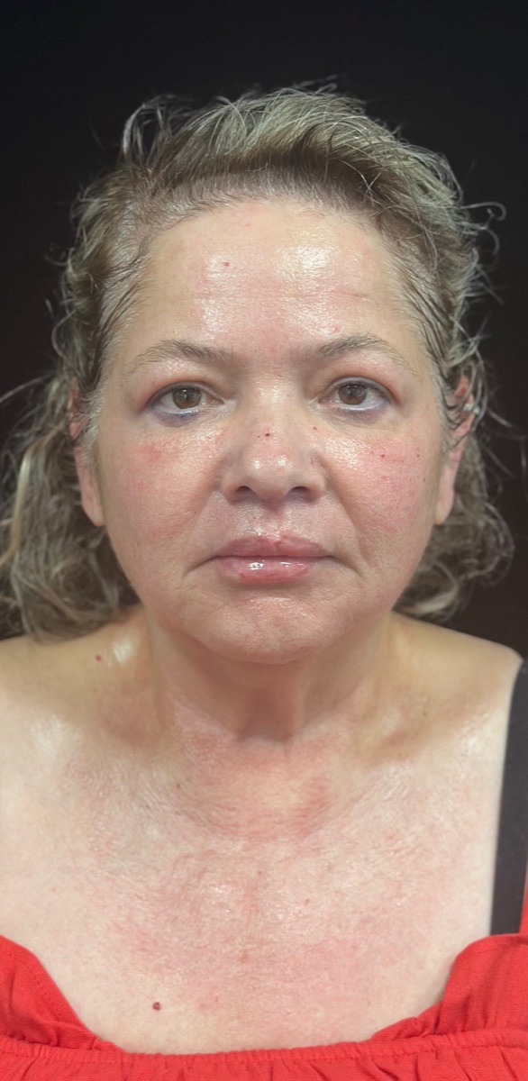 After: the same client's face and neck looking firmer and more refreshed