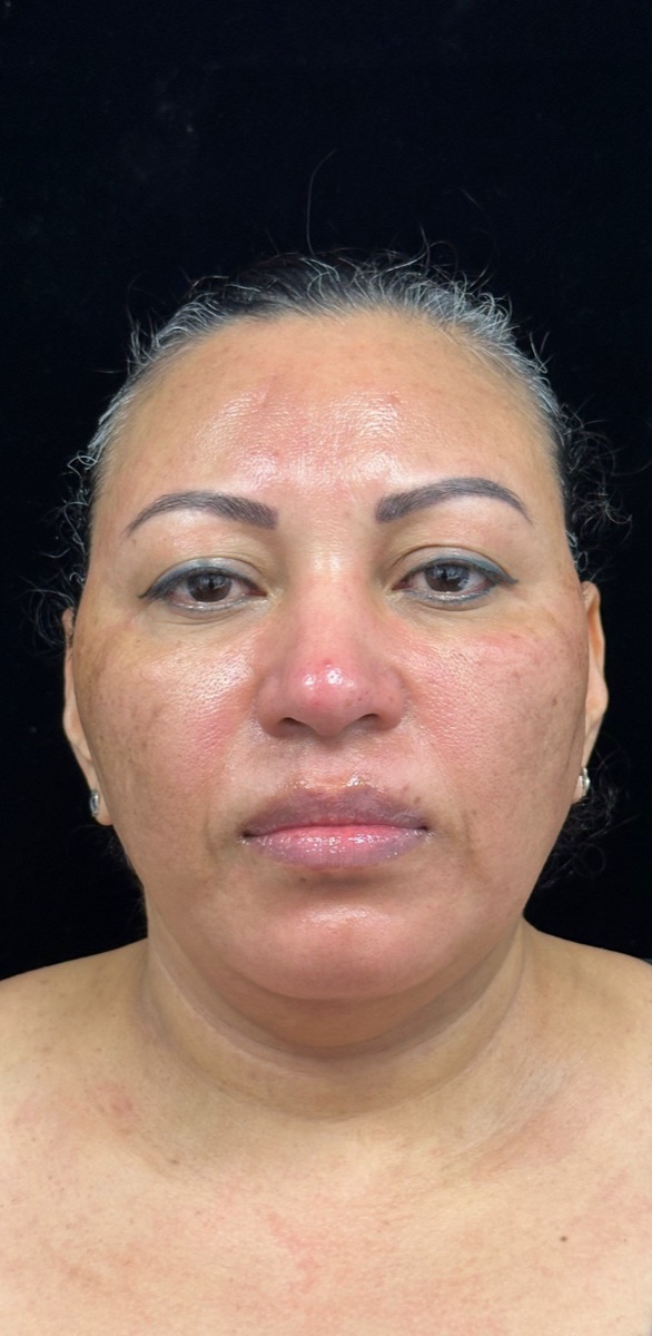 After: the same client's face with lighter spots and a more even tone